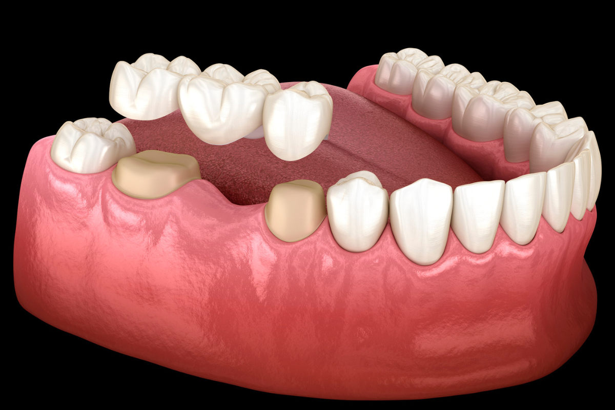 dental bridges
