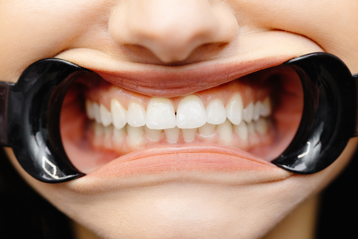 Advanced Teeth Whitening